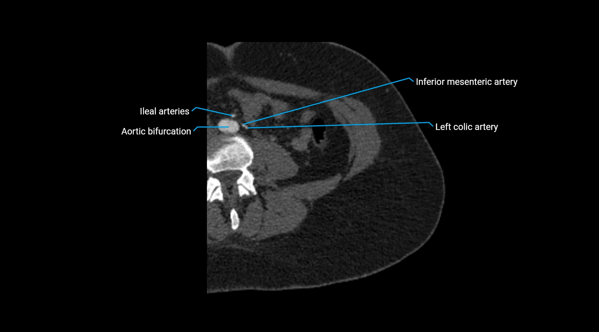 CTA lower limb cross sectional anatomy labelled image _2.webp